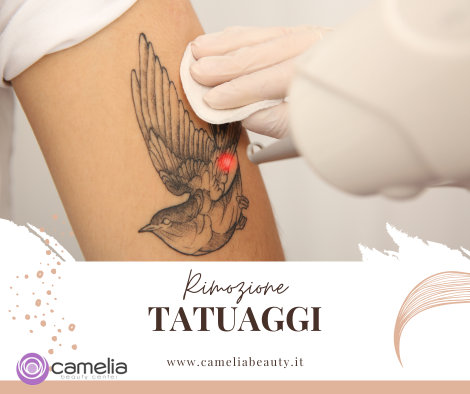 Rimozione tatuaggio a Bergamo con tecnologie avanzate